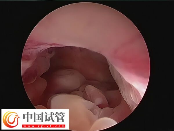 子宮內(nèi)膜息肉會(huì)不會(huì)影響試管嬰兒(圖1)