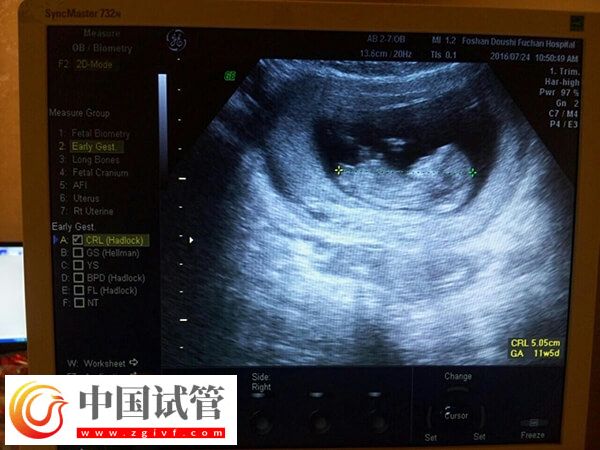 試管移植14天后做什么檢查(圖1)