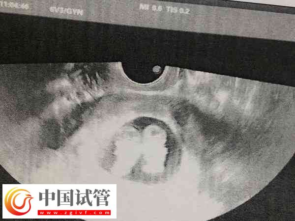 29歲試管雙胎的成功率高不高(圖2)