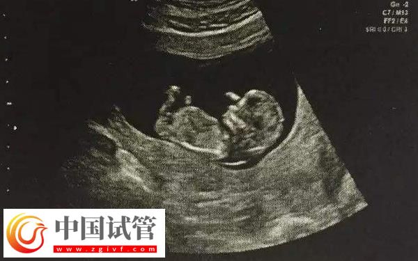 實施試管懷孕4個月穩不穩定(圖1)