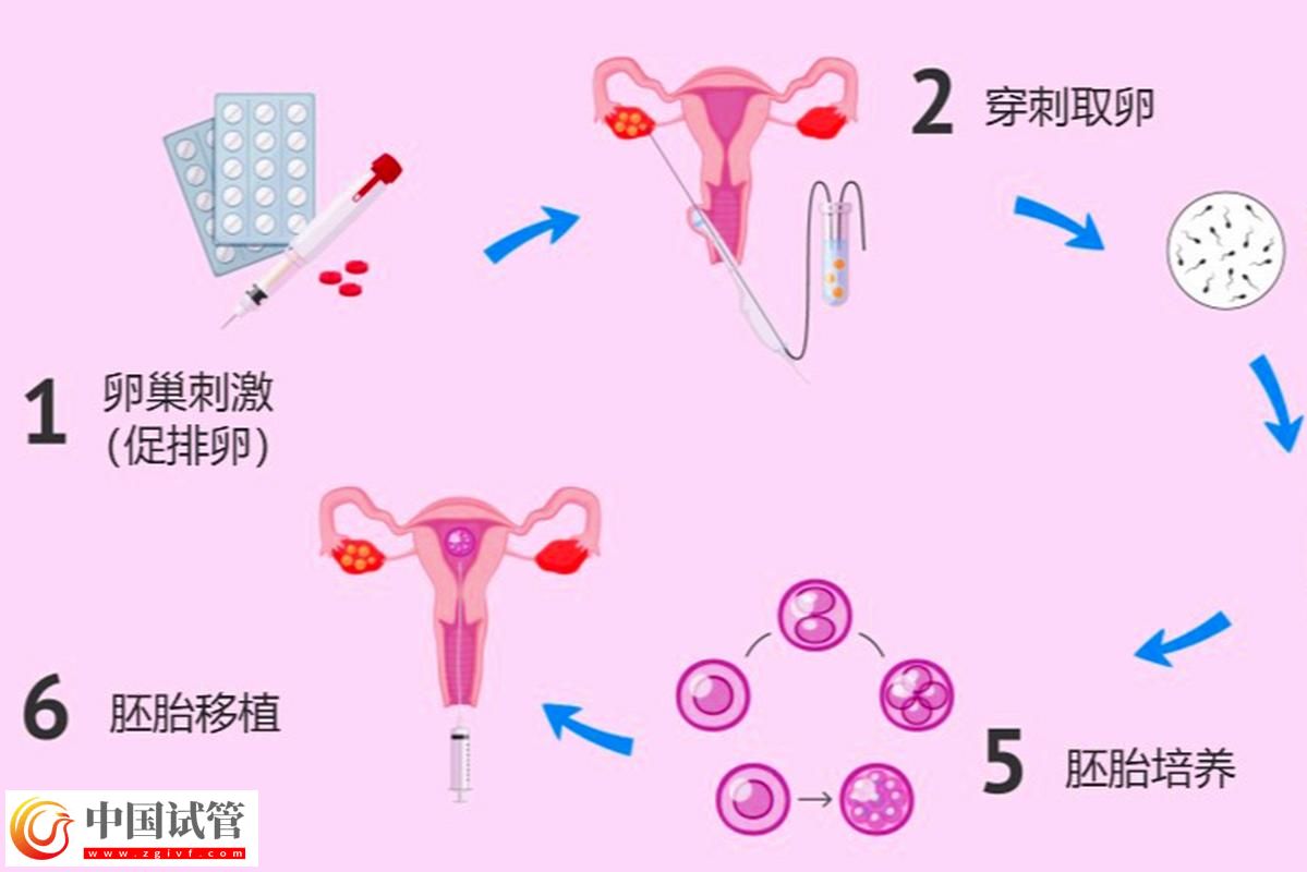 試管嬰兒從取卵到胚胎移植的完整流程(圖2) 試管嬰兒從取卵到胚胎移植的完整流程(圖2)