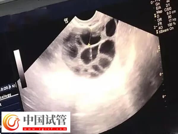 取卵18個(gè)能配多少胚胎(圖2)