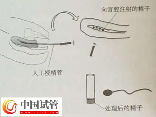 吉安市婦幼保健院人工授精的治療流程是怎么樣的？(圖3)