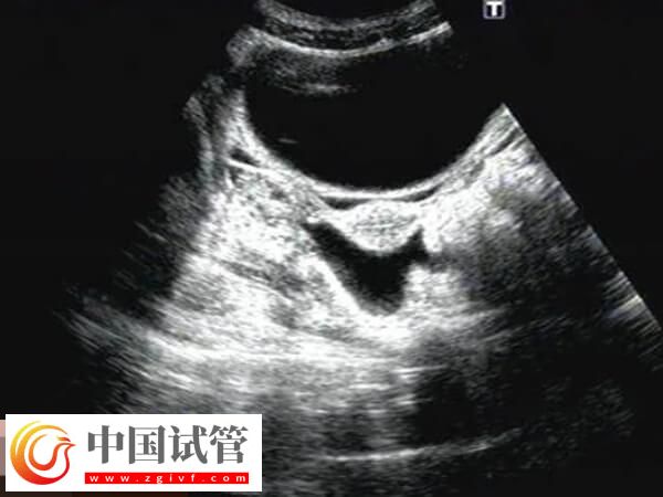 鮮胚移植后宮腔積液要注意，多久才能吸收一看便知(圖1)