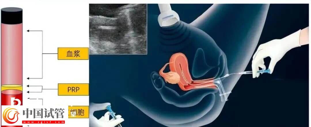 宮腔灌注具體的操作流程是怎么樣的？需要幾分鐘完成？(圖1)