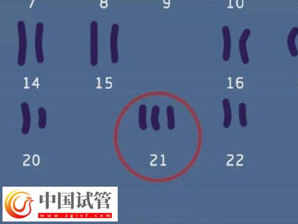 22號(hào)染色體異常還能不能要孩子(圖2)