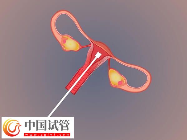 不經(jīng)中介去泰國做試管要怎么做(圖1)