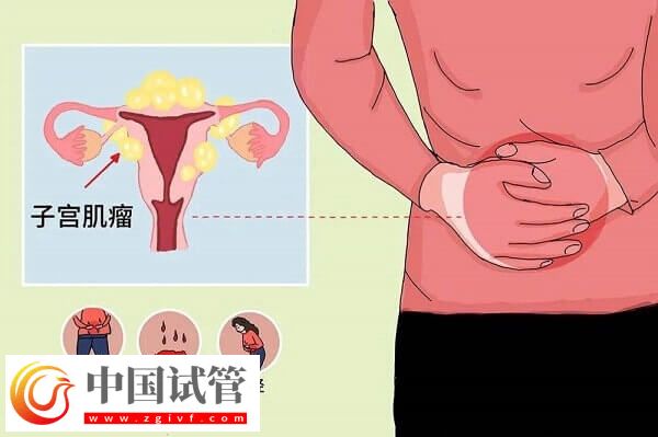 子宮肌瘤是什么原因?qū)е碌??專家解讀子宮肌瘤的原因(圖1) 子宮肌瘤是什么原因?qū)е碌模繉<医庾x子宮肌瘤的原因(圖1)