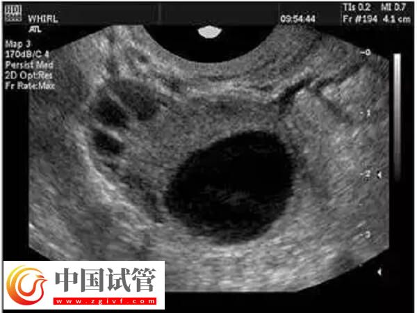 取卵為什么出現異形卵子(圖1)