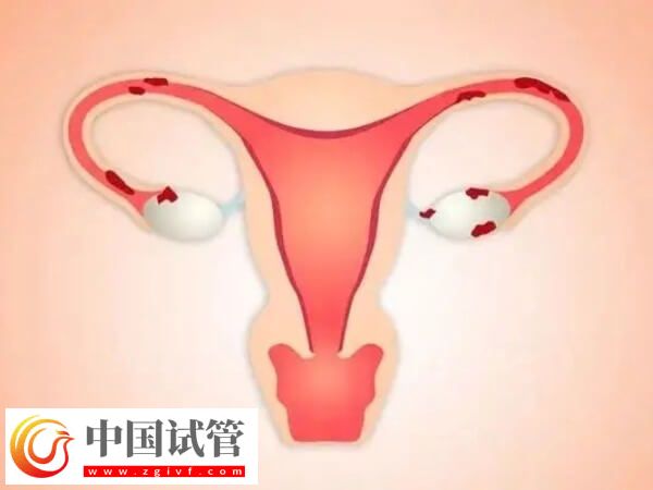 腔粘連不治會有什么后果(圖1) 腔粘連不治會有什么后果(圖1)